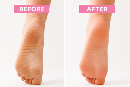 90 Minute Foot Renewal Mask – Exfoliating Foot Peel